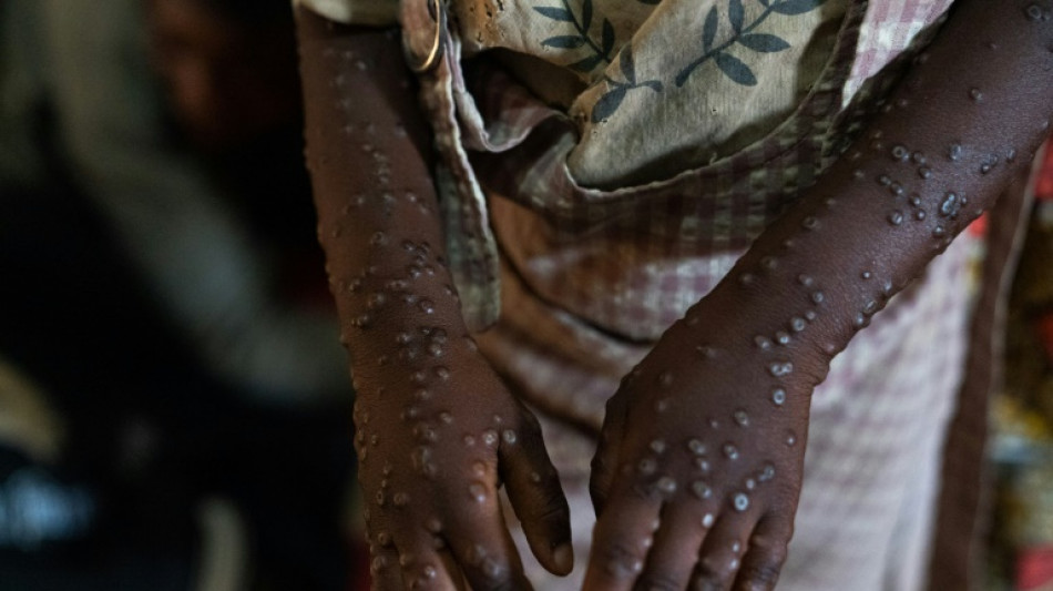 Pa&iacute;s mais afetado por surto de mpox, RD Congo come&ccedil;a campanha de vacina&ccedil;&atilde;o
